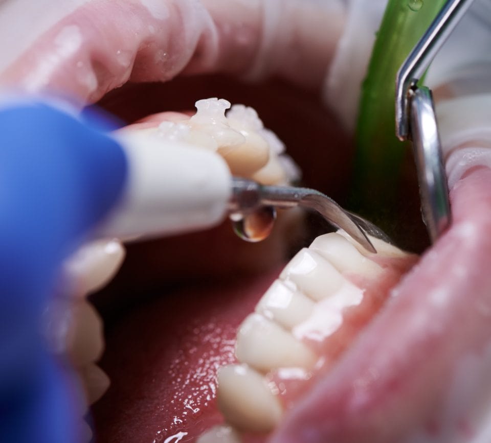 dental cleaning